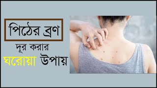 পিঠের ব্রণ দূর করার ঘরোয়া উপায় | Home Remedies for Acne | Tipsist