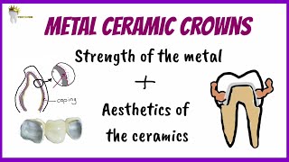 METAL CERAMIC CROWNS | How metal bonds to ceramic | Prosthodontics