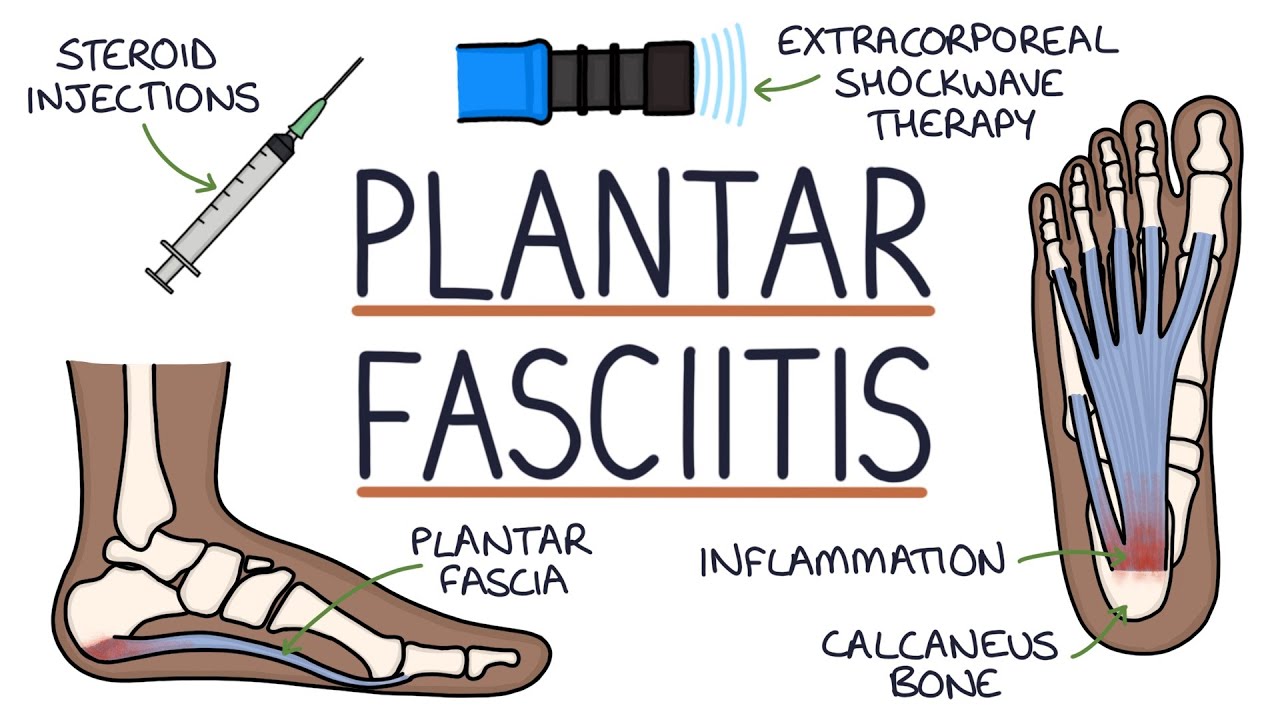 Understanding Plantar Fasciitis - YouTube