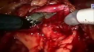 Robotic Pyeloplasty