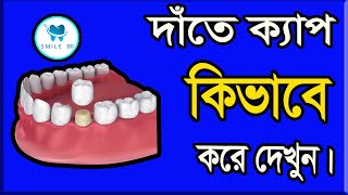 দাঁতে ক্যাপ করার পদ্ধতি দেখুন।Dental Crown Procedure EXPLAINED in bangla by smile bd.