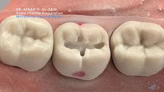 Class I cavity preparation for amalgam - mandibular molar #47 - Preclinical Operative - Arabic عربي