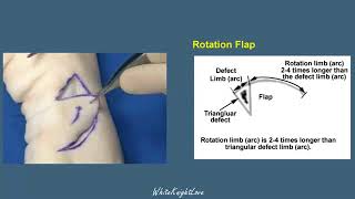8 3 Rotation Flap Skin Flaps Essential Surgical Skills WhiteKnightLove
