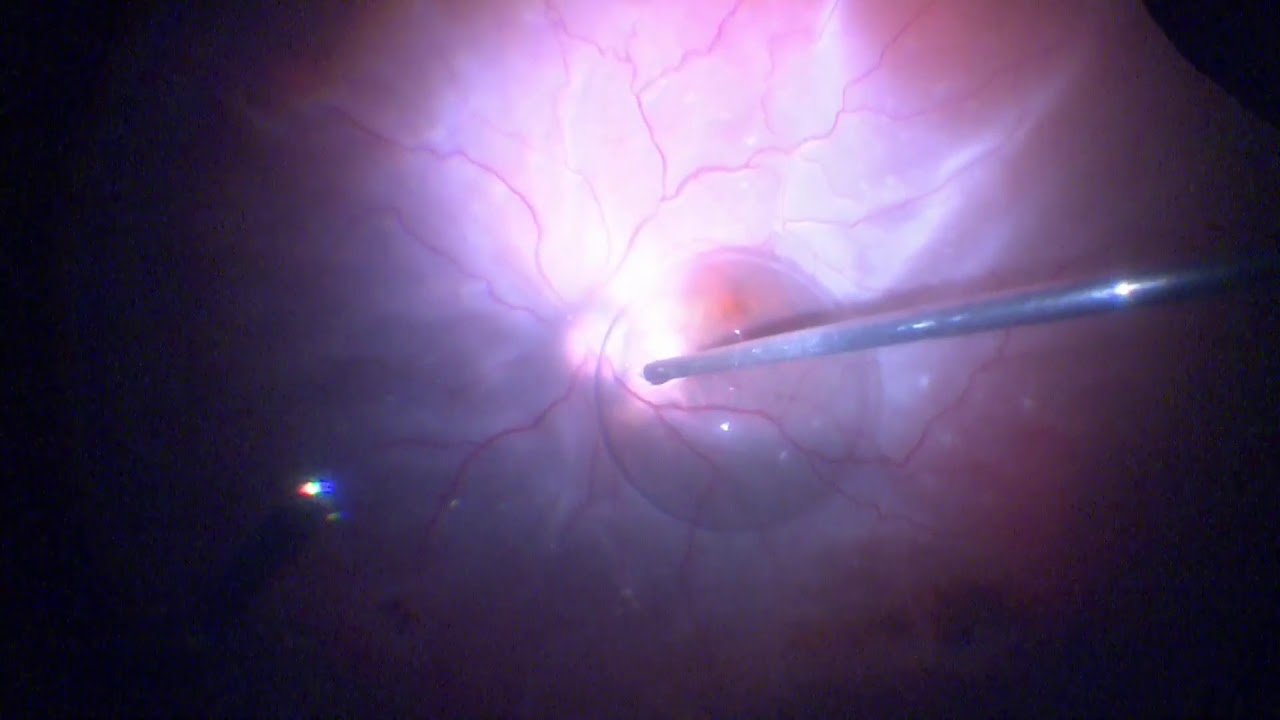 Surgery: Vitrectomy For Retinal Detachment: Assortment Of Cases - YouTube