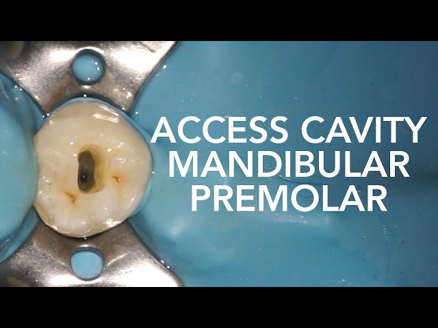 Access Cavity Of Mandibular Molar Lower Molar Access 48 Off