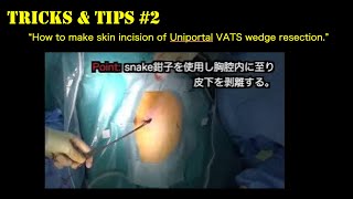 【Tricks \u0026 Tips #2】Making skin incision of Uniportal VATS wedge resection.