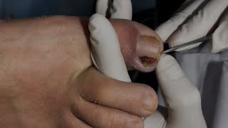 镶甲 paronychia ingrown toenailingrown nail treatment 234