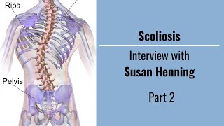 Scoliosis with Susan Henning Part 2