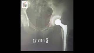 ក្រោយ​ដូរ​ត្រគាក​ថ្ងៃ​ទី​១​