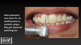 Microabrasion- Dental