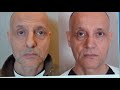 Natural Results in Rhinoplasty| Beverly Hills Profiles