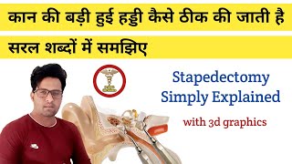 कान की हड्डी की सर्जरी सरल शब्दों में | कान में पिस्टन | Stapedectomy