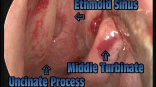 Functional Endoscopic Sinus Surgery ( FESS )