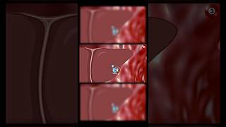 Dyslipidemia type 3 | Dysbetalipoproteinemia