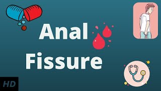 ANAL FISSURE? Causes, Signs and Symptoms, Diagnosis and Treatment