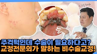 [교정일타 허원장] 주걱턱 수술이 필요하다고? 교정전문의가 말하는 비수술교정!