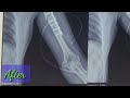 হাতের হাড় ভাঙ্গা অপারেশন shaft humerus fracture