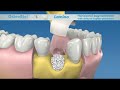 defecto de tres paredes osteobiol lamina