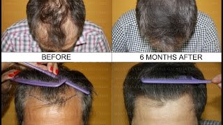 Hair Transplantation-1100 grafts/Трансплантация на коса-1100 присадки/д-р Зарев