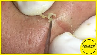 Suri Job 61: AWESOME WHITEHEADS EXTRACTION | PART 1