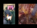 tvt under laparoscopic control