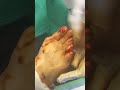 Prepping the bunion before surgery!