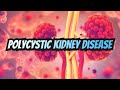 Polycystic Kidney Disease (updated 2023) - CRASH! Medical Review Series