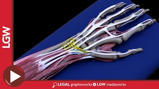 Wrist Fixator Surgery 3D Animation | Operative Report of 2018