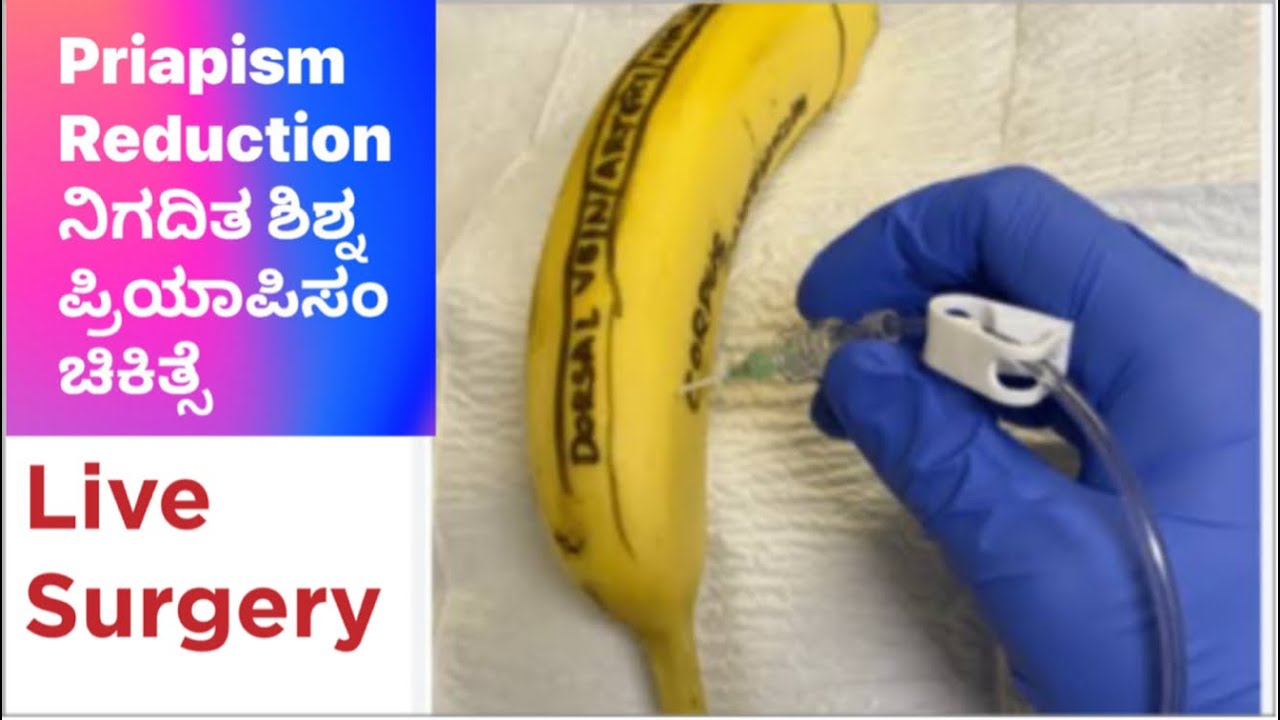 Warning: Live Surgery. Priapism Reduction. ಪ್ರಿಯಾಪಿಸಮ್. Dr C Sharath ...