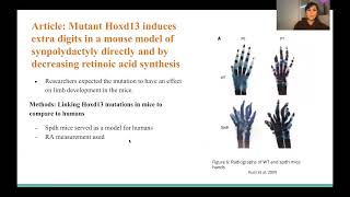 Brachydactyly Type D