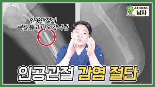 인공관절 감염의 가슴 아픈 케이스｜인공관절 감염 절단 케이스｜수술 읽어주는 남자👨‍⚕️