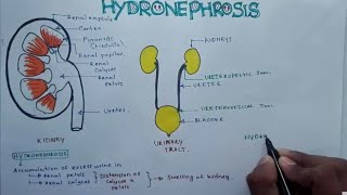 HYDRONEPHROSIS : Pathophysiology, Causes, signs and symptoms, background, diagnosis and treatment