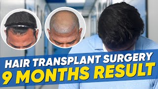 Hair Transplant in Hubli | Best Results \u0026 Cost of Hair Transplant in Hubli