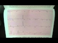 EKG ECG electrocardiogram Cardiologist Cardiology www.drbenzur.com