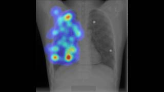Eye Tracking and Radiography a Moving Heatmap