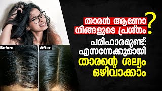 താരൻആണോ നിങ്ങളുടെ പ്രശ്നം, പരിഹാരമുണ്ട്‌: എന്നന്നേക്കുമായി താരന്റെ ശല്യം ഒഴിവാക്കാം, Lifestyle Focus