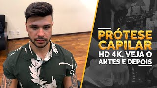 Prótese Capilar HD 4K, veja o antes e depois