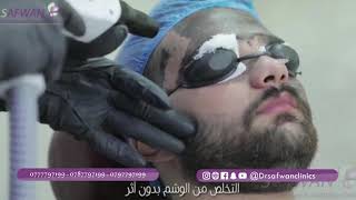 التقشير الكربوني 5 - عيادات الدكتور صفوان - drsafwanclinics