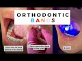 Orthodontist Explains How to band teeth. Banding braces. #shorts