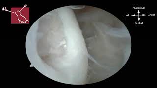 Arthroscopy of MTP - 1