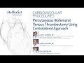 Percutaneous Iliofem Venous Thrombectomy Contralateral Approach (P Haddad, A Mohamed, A Lumsden, MD)