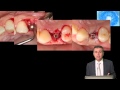 203-00 Implants in the Anterior Region - Surgical Techniques for Ultimate Esthetics PREVIEW