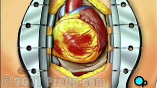 outoffears# Heart -Coronary Artery Bypass Graft (CABG off-pump) PreOp® Patient Education HD