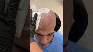 Cabello tatuado ! Smp . Scalp micropigmentation . El cambio es inmediato . Solución a la calvicie .