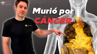 ¿Por qué es tan difícil matar el cáncer?