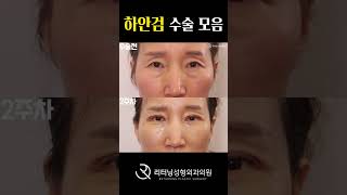 하안검수술 찐 환자들이 진짜 후기