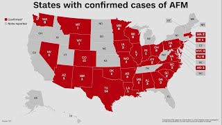 CDC confirms first case of rare polio-like illness in Louisiana