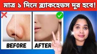 ব্ল্যাকহেডস ও হোয়াইটহেডস দূর করার বৈজ্ঞানিক উপায়। Blackheads/Whiteheads remove