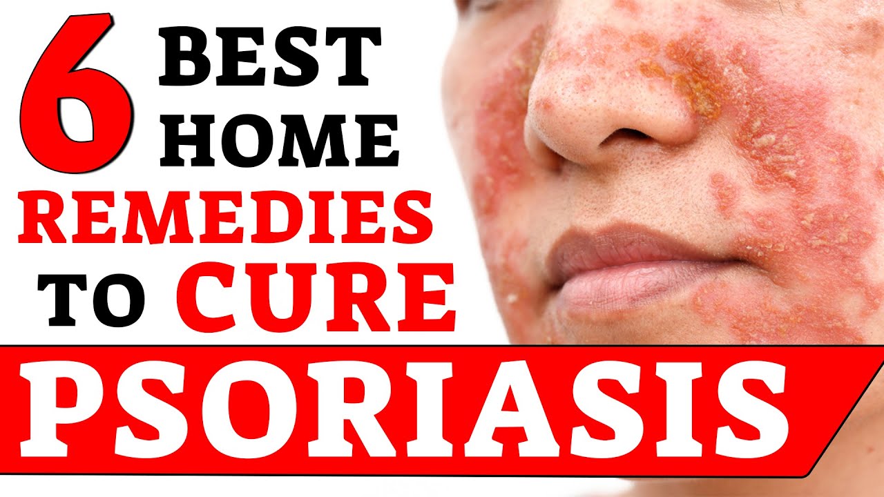 Best 6 Remedies To Cure Psoriasis | Psoriasis Treatment | Bharat ...