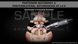 Posterior Interbody & Posterolateral Arthrodesis at L4-5 - Medical Animation